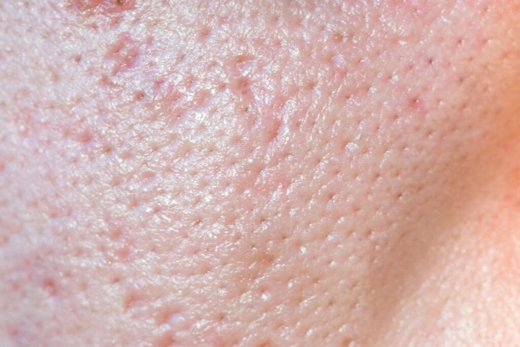 Close up photo of a clogged pores