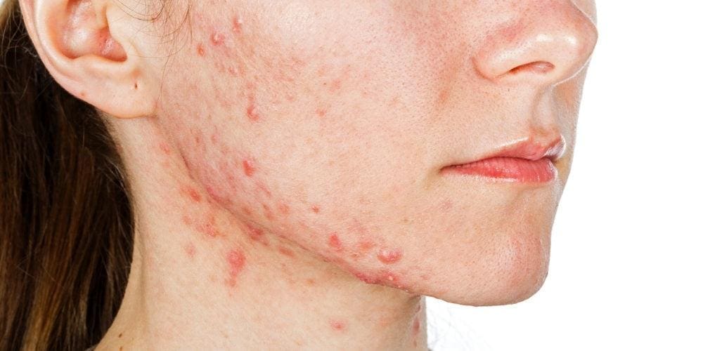 Can Your Skin Type Change? 3 Close up photo showing how hormonal changes affects skin