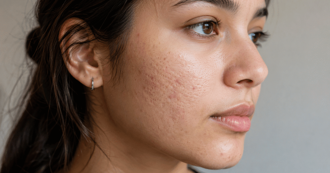 How long do acne scars last