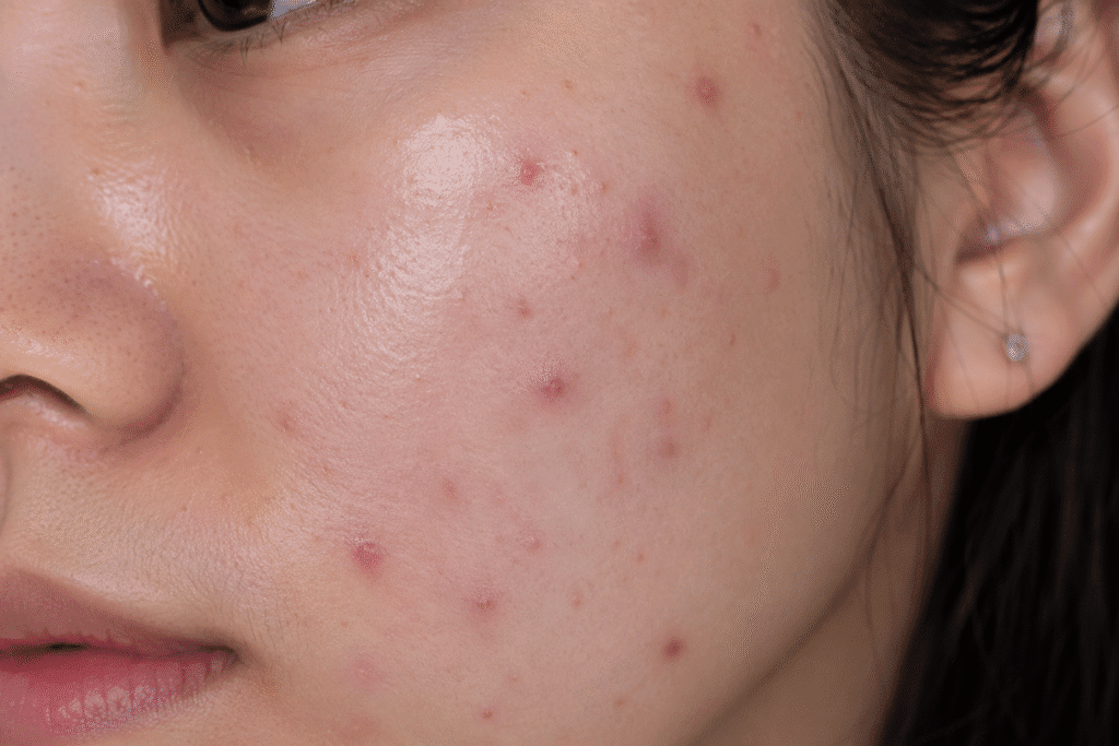 Close-up of a person's cheek showing purging skin