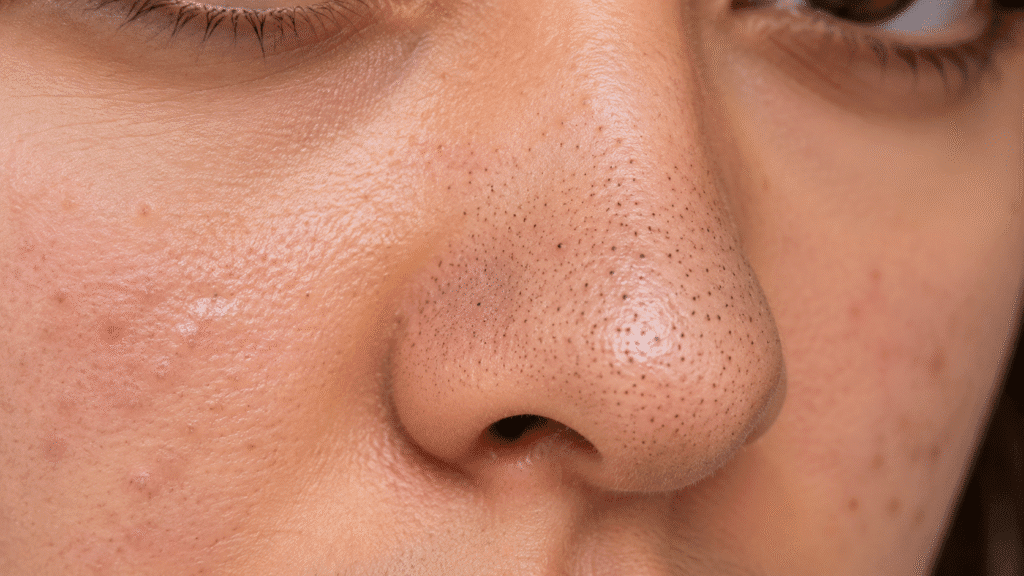 Close up photo of face with blackheads