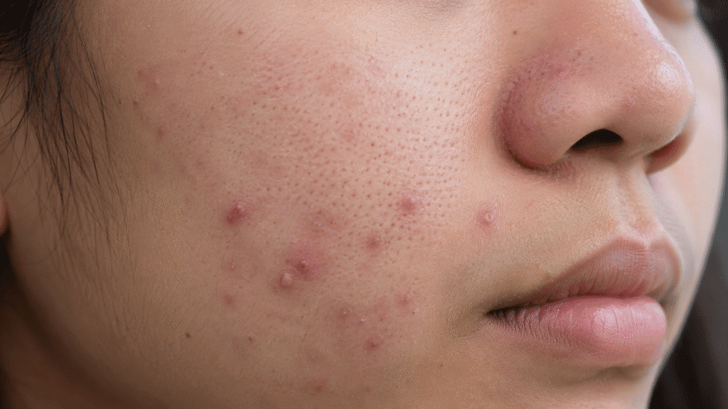 Close up photo of an acne breakout