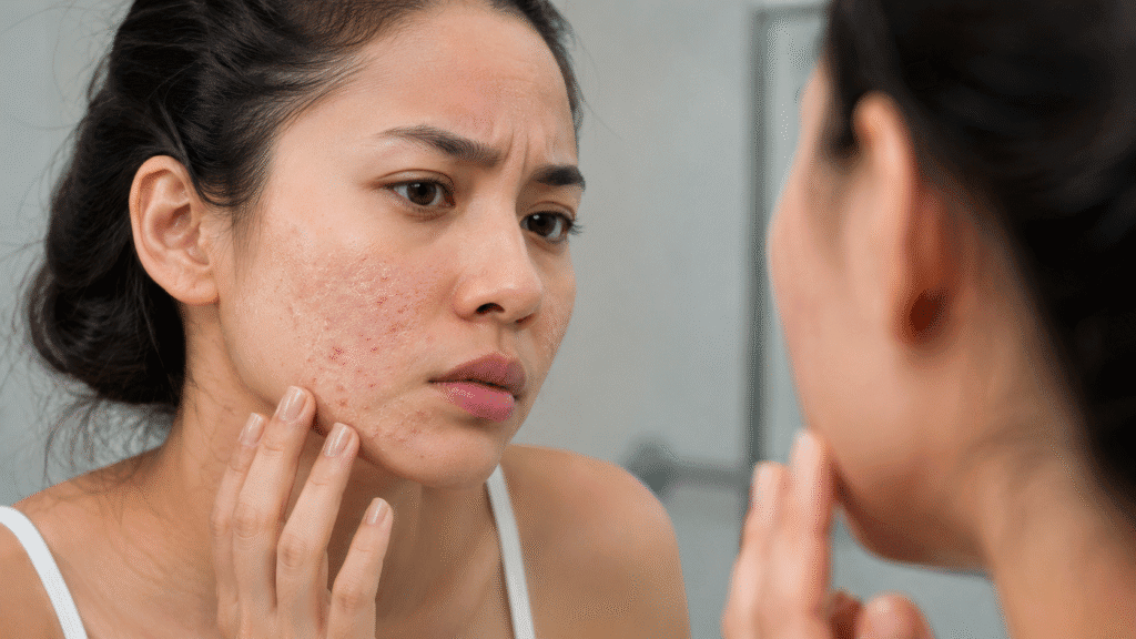 Can Dry Skin Make You Break Out