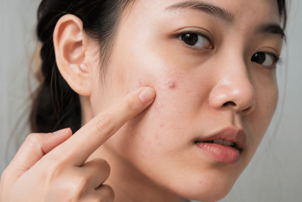 How to Pop a Pimple: What You Need to Know Before You Start 1 Close-up of a woman pointing at a pimple on her cheek.