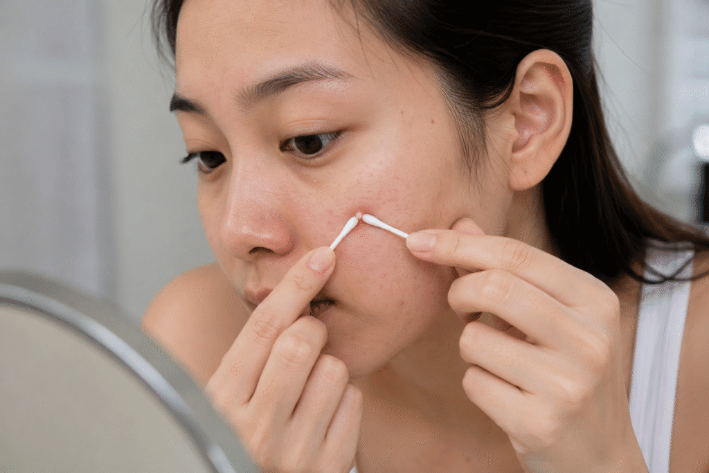 How to Pop a Pimple: What You Need to Know Before You Start 2 Woman popping a pimple on her cheek using cotton swabs.