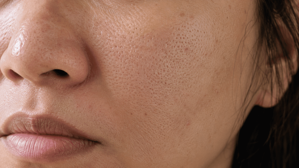 Close-up of enlarged facial pores.